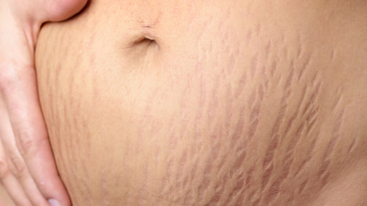 stretch mark tattoo